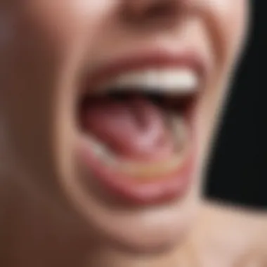 Oral Cavity Affected by Gingivostomatitis Illustration depicting the oral cavity affected by gingivostomatitis, showing inflammation and ulceration.