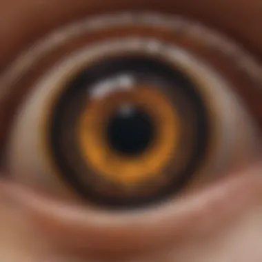 Formation of Macular Drusen Illustration of macular drusen formation beneath the retina