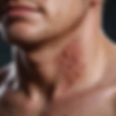 Distinct Characteristics of MRSA Rash Close-up view of a MRSA rash on skin showing distinct characteristics